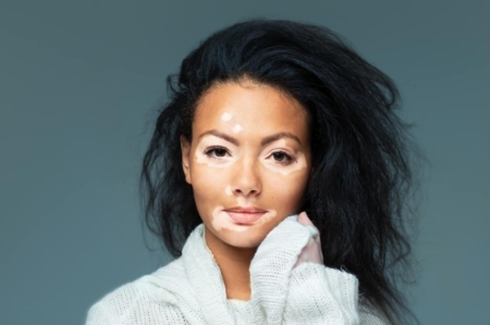 Woman with vitiligo skin disorder